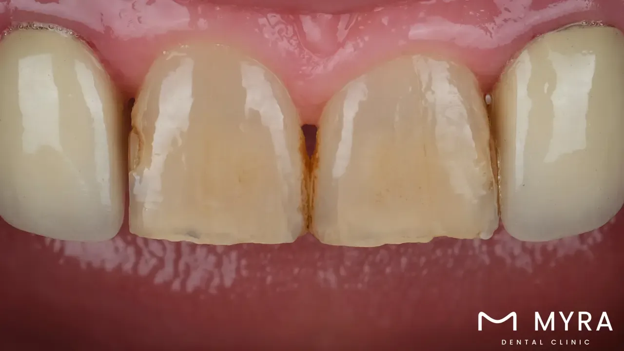 when is a dental root canal applied?